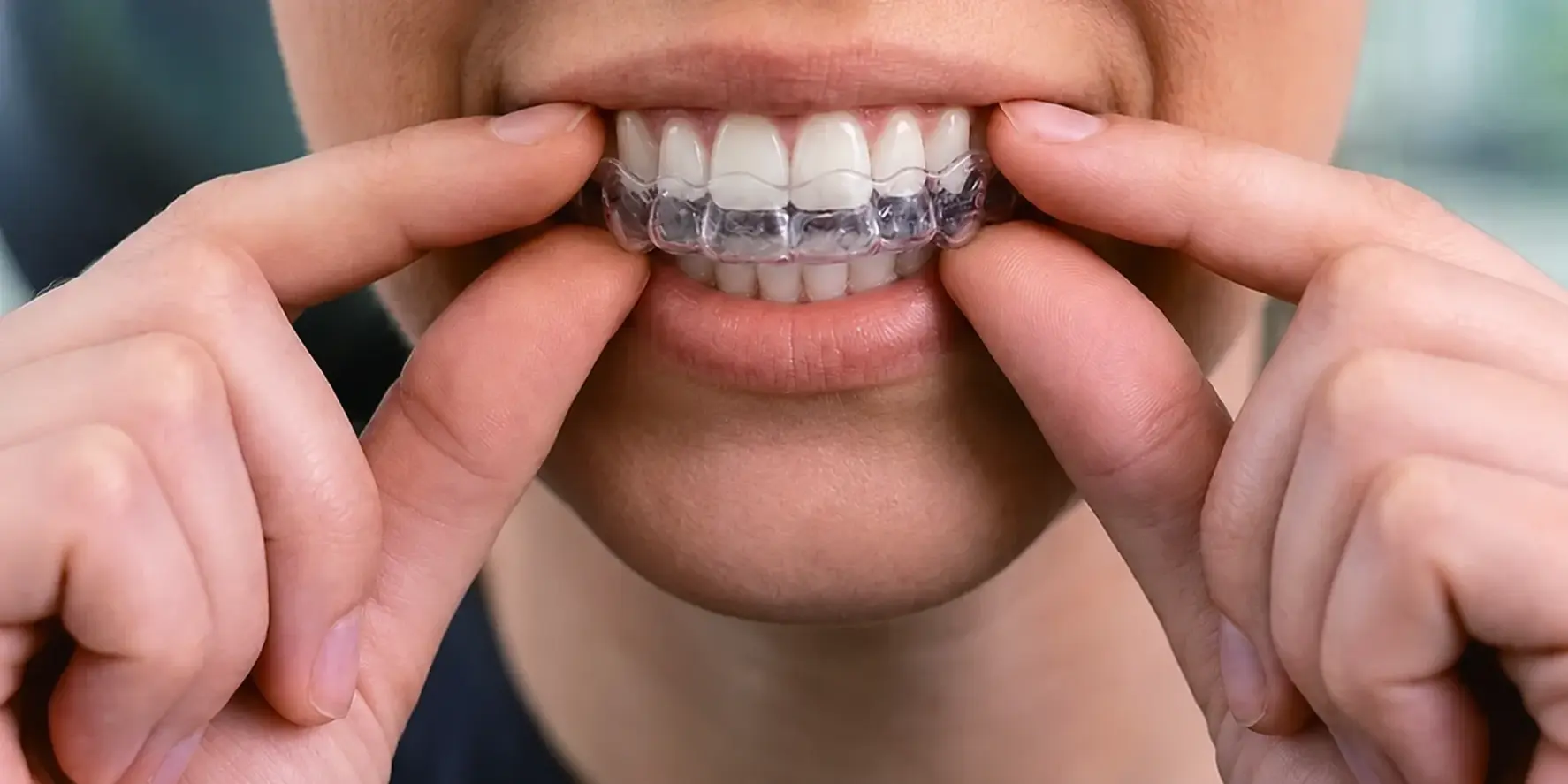Insert aligners step 3