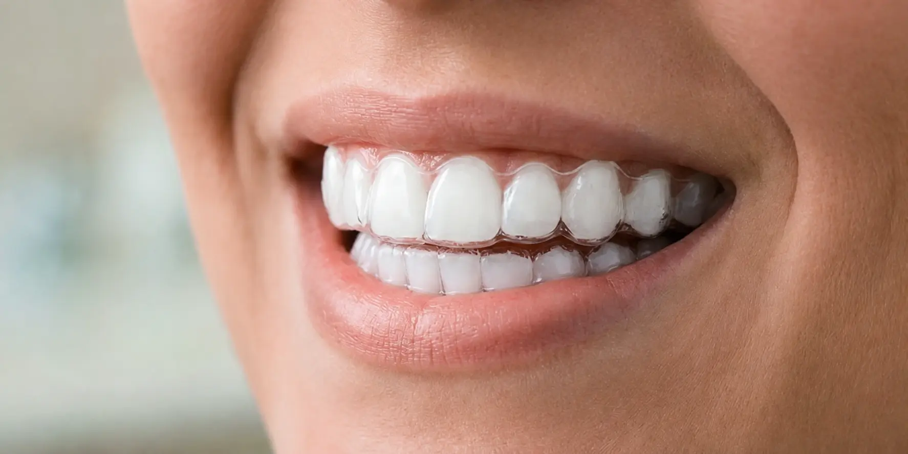 Insert aligners step 4