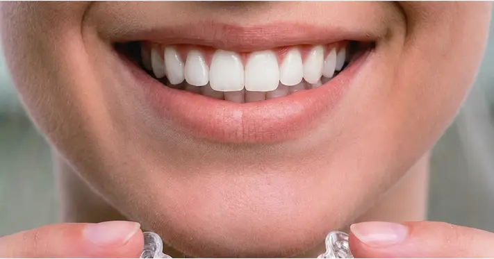 Remove aligners step 3