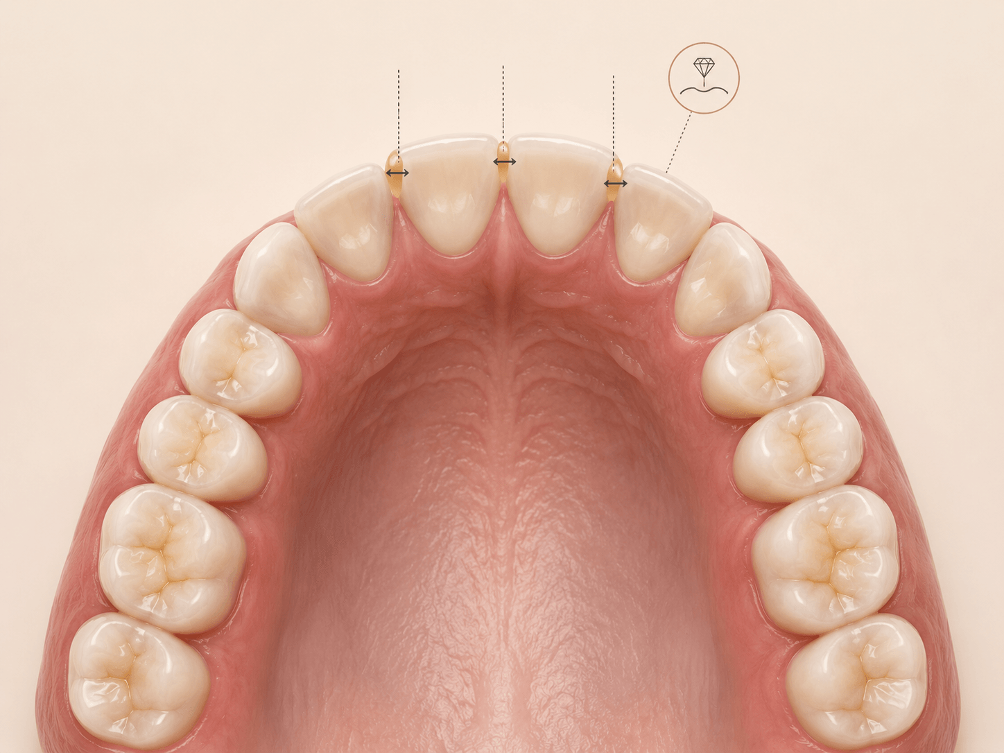 Upper dental arch with highlighted interproximal contact zones for space and IPR review