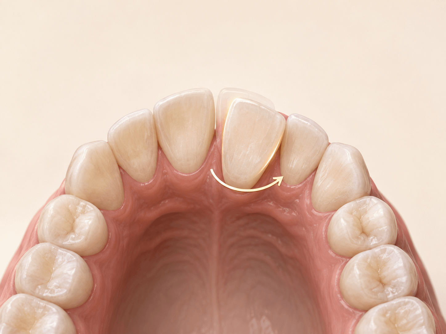 Occlusal view showing a rotated anterior tooth and its planned refinement position